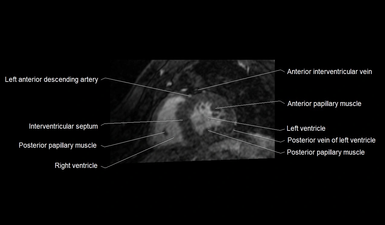 MRI heart and coronary arteries short axis anatomy image 28.webp